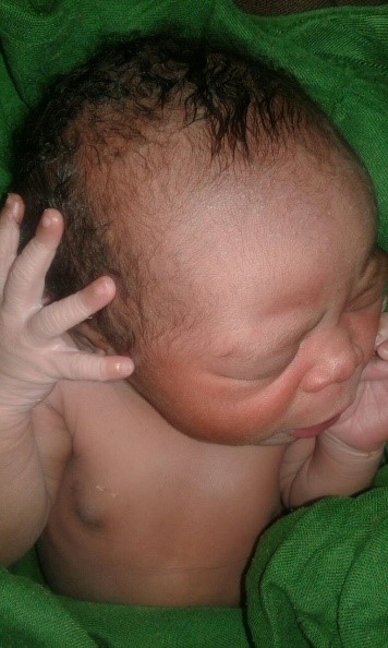 Filipe´s newborn after resuscitation.